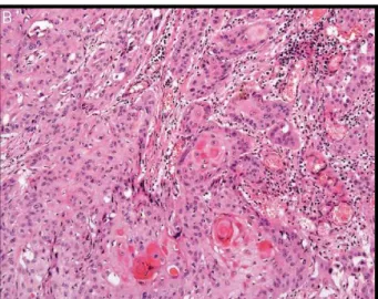 Figura 7. Carcinoma de células escamosas invasivo moderadamente diferenciado Grau II(HeE X100)