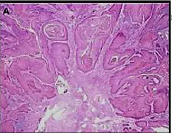 Figura 9. Carcinoma Epidermóide do subtipo histológico Usual(HeE X100).(Fonte: arquivo pessoal)