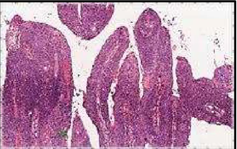 Figura 11. Carcinoma epidermóide do subtipo histológico papilífero(HeE X100).(Fonte: arquivo pessoal)