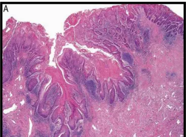 Figura 12. Carcinoma epidermóide do subtipo histológico condilomatoso(Warty) (HeE X100).(Fonte: Chauxet  al, 2010)