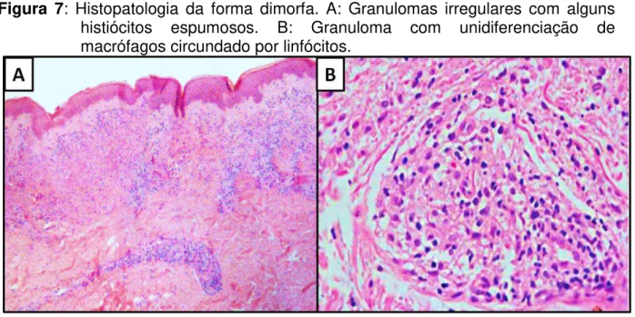 Figura  7:  Histopatologia  da  forma  dimorfa.  A:  Granulomas  irregulares  com  alguns  histiócitos  espumosos