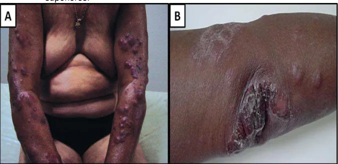 Figura 10: Manifestações clínicas do eritema nodoso hansênico mostrando em A e  B  nódulos  inflamatórios  com  distribuição  simétrica  nos  membros  superiores