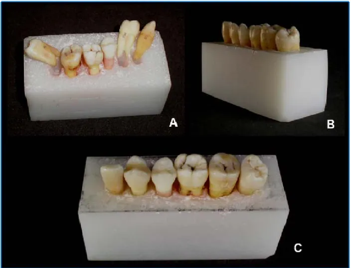 Figura 7. Modelo real concluído. A. Dentes removidos dos alvéolos artificiais para  limpeza com jato de água quente; B