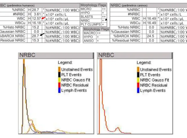 Figura 12 Análise duma amostra com 22% de NRBC com parâmetros humanos (à esquerda) e parâmetros caninos  (à direita) na Advia®2120
