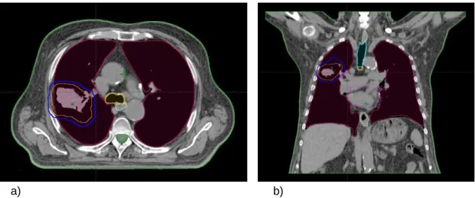 Figura 4.6 – Imagem do corte axial (a) e coronal (b) de uma TC de planeamento num caso de  tumor de pulmão, inclui o CTV (linha laranja), o PTV (linha azul), e os OR, medula (linha verde  escura), pulmões (linha púrpura), coração (linha magenta) e esófago 
