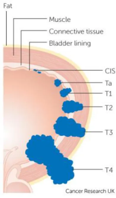 Figure  1.  Bladder  layers  and  bladder  cancer  progression  (non-invasive  tumours:  stages  CIS,  Ta  and T1; invasive tumours: T2-4) Adapted from (http://www.cancerresearchuk.org/) 