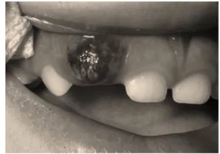 Figura 9 - Reportagem da prevalência dos sintomas da erupção da dentição decídua. 