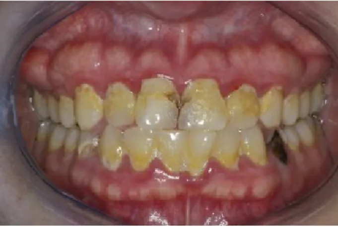 Figura  4  –  Paciente  com alto  risco  de  cárie,  com carga  bacteriana  e cuidados  de  higiene  oral  escassos  (Adaptado de Kutsch, 2014).