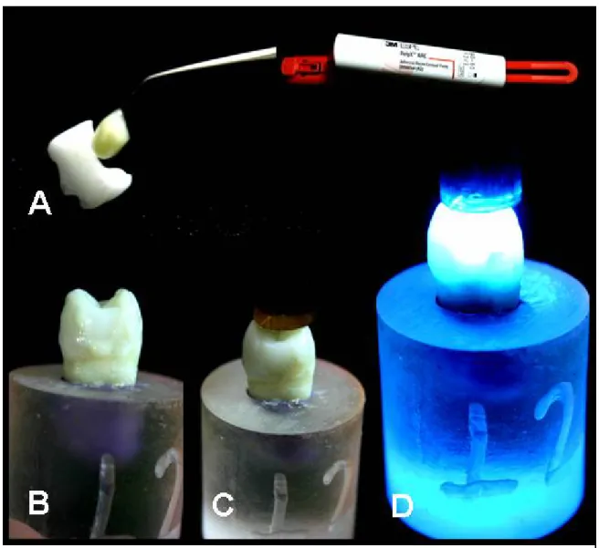 Figura 9. Processo de fixação das restaurações indiretas; A. Aplicação do  cimento adesivo dual na face interna da restauração; B
