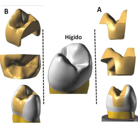 Figura 10. A- Restauração onlay; B-  Restauração Inlay, ambas mimetizam a  forma coronária do dente hígido  