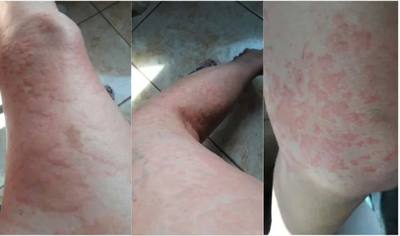Figure 4. skin diseases reported by the interviewees  