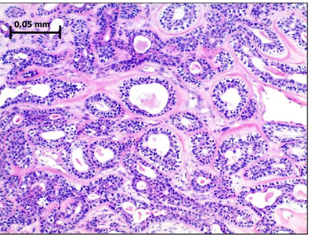 Figura  4-  Adenoma  de  células  basais  em  padrão  tubular.  Observa-se  numerosas  formações  ductiformes, de lúmens com diâmetros variados, células luminais e abluminais