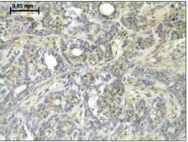 Figura  6-  Reatividade  imunoistoquímica  para  GSK3β  em  adenoma  de  células  basais  de  glândula salivar