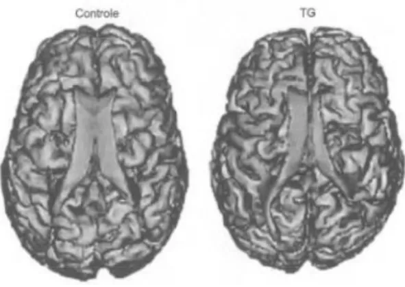 Fig  1:  Diferença  de  tamanhos  entre  os  ventrículos  esquerdo  e  direito  de  cada  cérebro