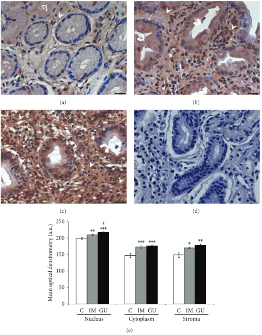 Figure 2: Expression of annexin-A1 protein in gastric mucosa (a–c). (a) Expression of AnxA1 in normal mucosa (C), predominantly in the cytoplasm of epithelial cells (curved arrow) and stroma (arrowhead)
