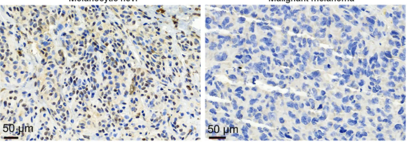Figure 1. Expression level of nucleolar protein 14 (NOP14) in malignant melanoma tissues and melanocytic nevi tissues