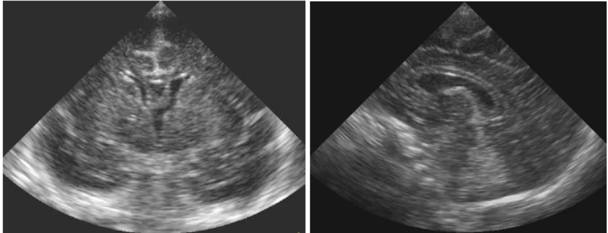 Figura  4  -  Imagem  de  ultrassonografia  cerebral  normal  mostrando  corte  no  plano  coronal IV e plano sagital mediano