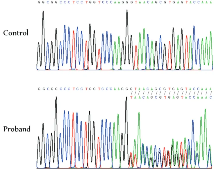 Figure 2 - Electropherogram showing the COL1A1 c.1290delG mutation in heterozygosis in the proband compared to a normal control.