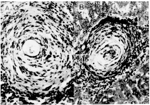 Fig. 2: hepatic granuloma photomicrographs (x 250) of BALB/c mice, eight weeks after challenge infection, in either non-immu- non-immu-nized (A) or PIII immunon-immu-nized ones (B)