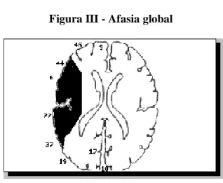Figura III - Afasia global 