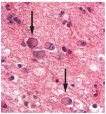 Figura  2  –  Cérebro  de  doente  com  DFT,  evidenciando  a  atrofia  selectiva  dos  lobos  frontal  e  temporal  (Neumann et al., 2009)