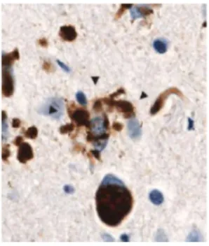 Figura  3  –  Histopatologia  de  DLFT–TAU:  inclusões  de  tau  anormal  nos  corpos  de  Pick  e  na  astroglia  ramificada (setas) (Rabinovici e Miller, 2010)