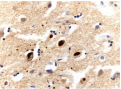 Figura 6 - Histopatologia da DLFT–FUS: inclusões citoplasmáticas neuronais imunorreativas à FUS (Snowden,  2011)
