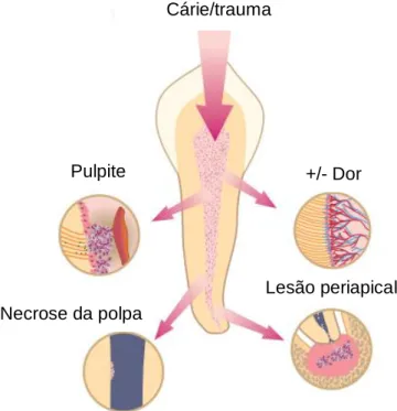 Figura  7  –  Reações  adversas  da  polpa  à  infeção  bacteriana/trauma:  pulpite,  dor,  necrose  da  polpa  e  lesão  periapical