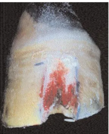 Figure 7 - Total Resection of a keratoma. Adapted from  Smith et al., 2006 