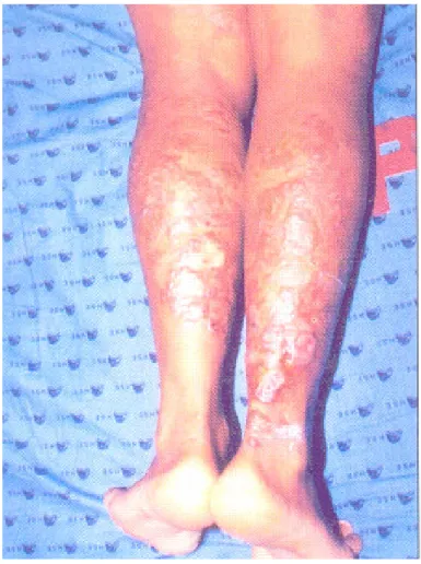 Foto  5  -  Forma  Cutânea  Difusa  localiza  na  face  posterior  da  perna direita. 