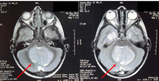 Figura 2C: Meduloblastoma evidenciado em RNM de encéfalo T2 coronal. 