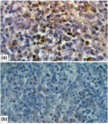 Figura  2D:  Histopatologia  do  Meduloblastoma.  Imunorreatividade  para  mutação  de  TP53  (a)  e  imunohistoquímica negativa para mutação de TP53 (b)