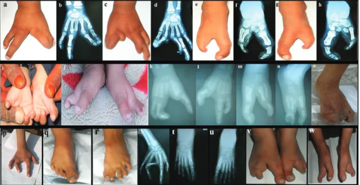 Figure 2 - Clinical features of split hand/foot malformation (SHFM) observed in family A