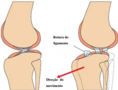 Figura 2: O LCCr impede o movimento de translação tibial. Dto – joelho saudável; Esq – joelho  com rotura do LCCr (adaptado de Schulz, 2013).
