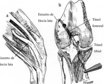 Figura 6: Técnica de Paatsama. a - corte da banda da fáscia lata; b - passagem pelos  túneis ósseos do fémur e da tíbia (adaptado de ARNOCZKY, 2004 ).