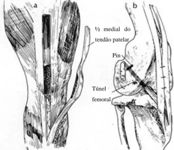 Figura 7: Técnica do tendão patelar. a - corte do terço medio do tendão patelar; b - passagem  através do túnel ósseo e fixação através de pin com posterior sutura ao músculo gastrocnémios  (adaptado de ARNOCZKY, 2004)