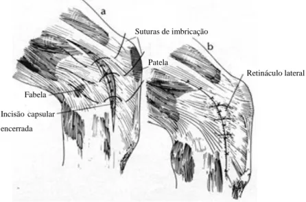 Figura 10: Técnica de imbricação da fáscia lata. a – Encerramento da  incisão cápsular; b – sutura de imbricação com pontos de Lembert ao longo da  fáscia lateral (adaptado de ARNOCZKY, 2004)