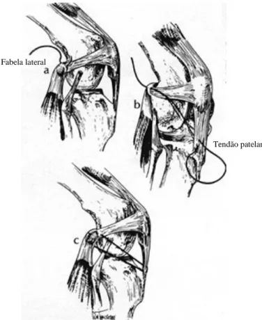 Figura 11: Técnica de imbricação retinacular lateral. a – Colocação da sutura no tecido conjuntivo  denso em torno da fabela; b – passagem pelo terço distal do tendão patelar; c – Sutura completa com  membro em posição funcional (adaptado de ARNOCZKY, 2004