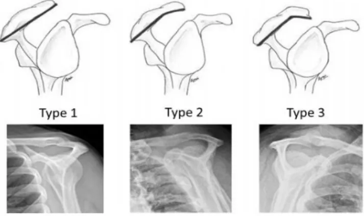 Figure 8. Bigliani's classification of acromion undersurface with corresponding supraspinatus outlet view  radiograph