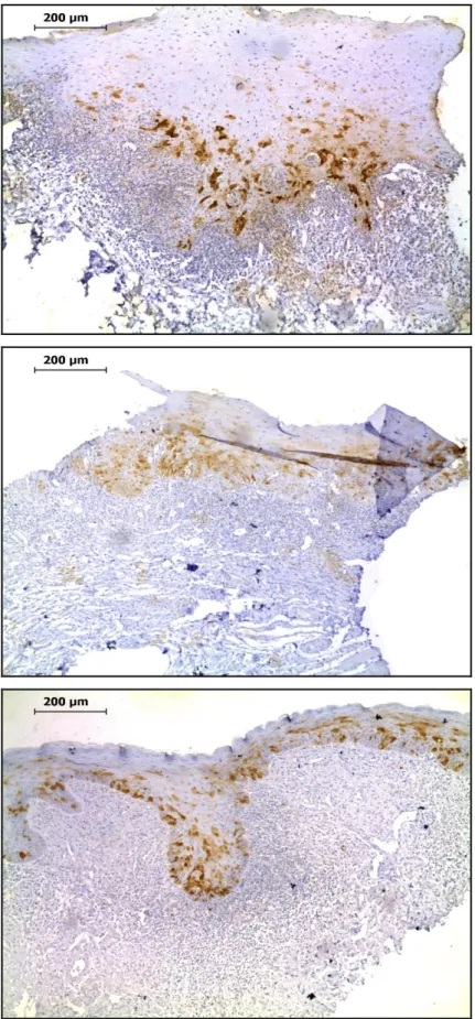 Figura 5 – Imagens representativas da reatividade imuno-histoquímica para p16 em amostras de líquen  plano  oral  reticular  (A),  líquen  plano  atrófico/erosivo  (B),  e  reação  liquenóide  oral  (C)