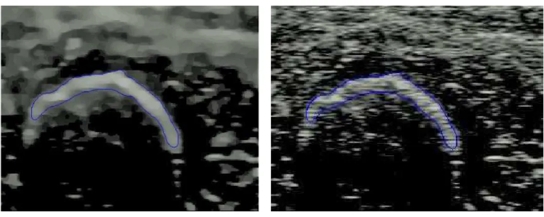 Figure 3.4: Result of segmentation in US image and contour overlay on the original image.