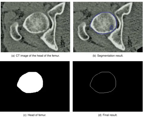 Figure 3.10: Segmentation steps of CT images, on the head of the femur, with the proposed method.
