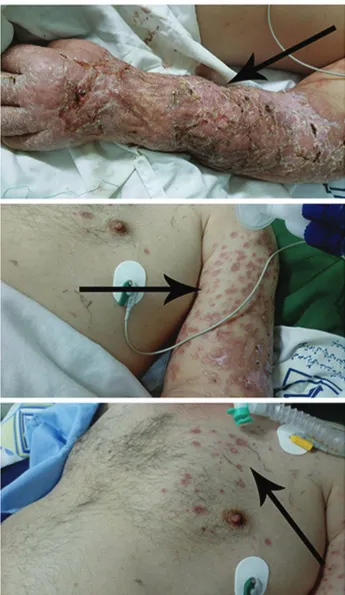 Figure 3 -  Patient with atypical disseminated cutaneous  leishmaniasis (DCL) showing good response to treatment with  amphotericin B and regression of his cutaneous lesions
