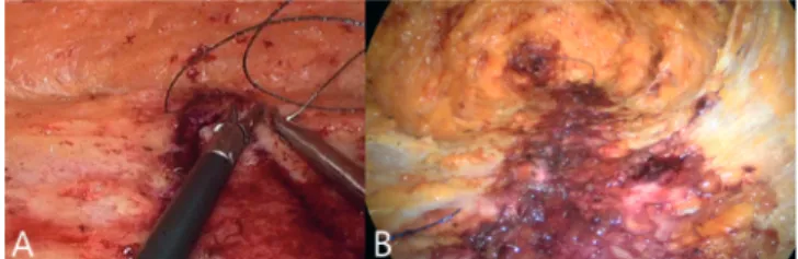 FIGURE 6 - A e B) Mesh convering DMRA plication in a pre- pre-aponerotic position (onlay) 