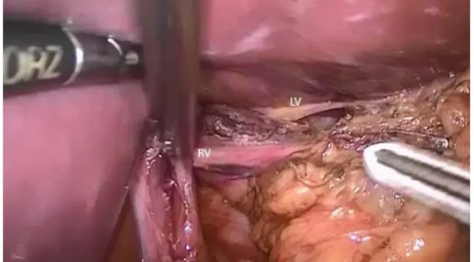 Figure 1   -  Completely  dissected  esophageal  segment. Details of the right and left vagal trunks
