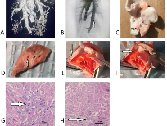 Figure 1 -  Images and pathology of pulmonary embolism. ( A ) Computed tomography ( B ) X-ray angiography of  pulmonary embolisms