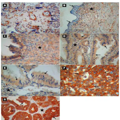Figure 1 – A.  Positive Control; Human plasenta. Immunohistochemical positive immunoreactivity of NF-kB  (arrow)