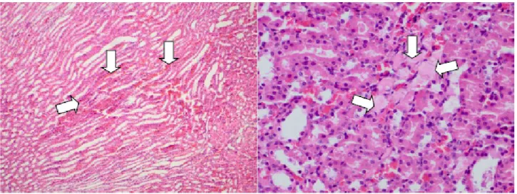 Figure 2 - A.  Intratubular hemorrhage (left).  B.  intratubular cast formations (H&amp;E x100).