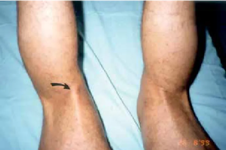 Figure 1. Visualization of the semitendinosus and/or gracilis tendons  on physical examination, with knee flexion against resistance