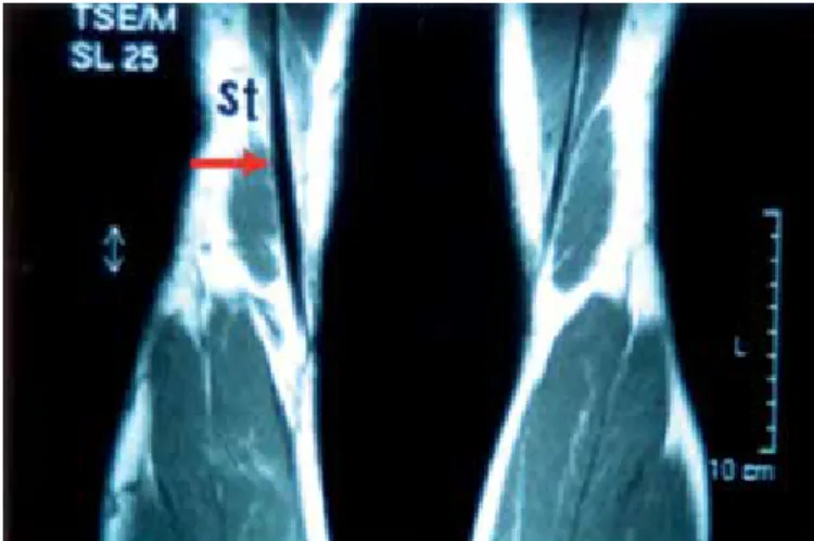 Table 1 shows that 25 (83.33%) of the ST tendons and 30 (100%) of  the G tendons were visualized with MRI, demonstrating regeneration